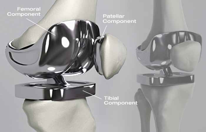 Step by Step Knee Replacement Surgery